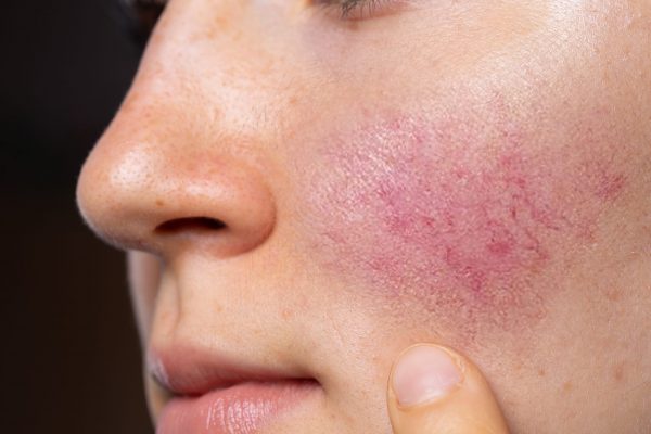 General Dermatology